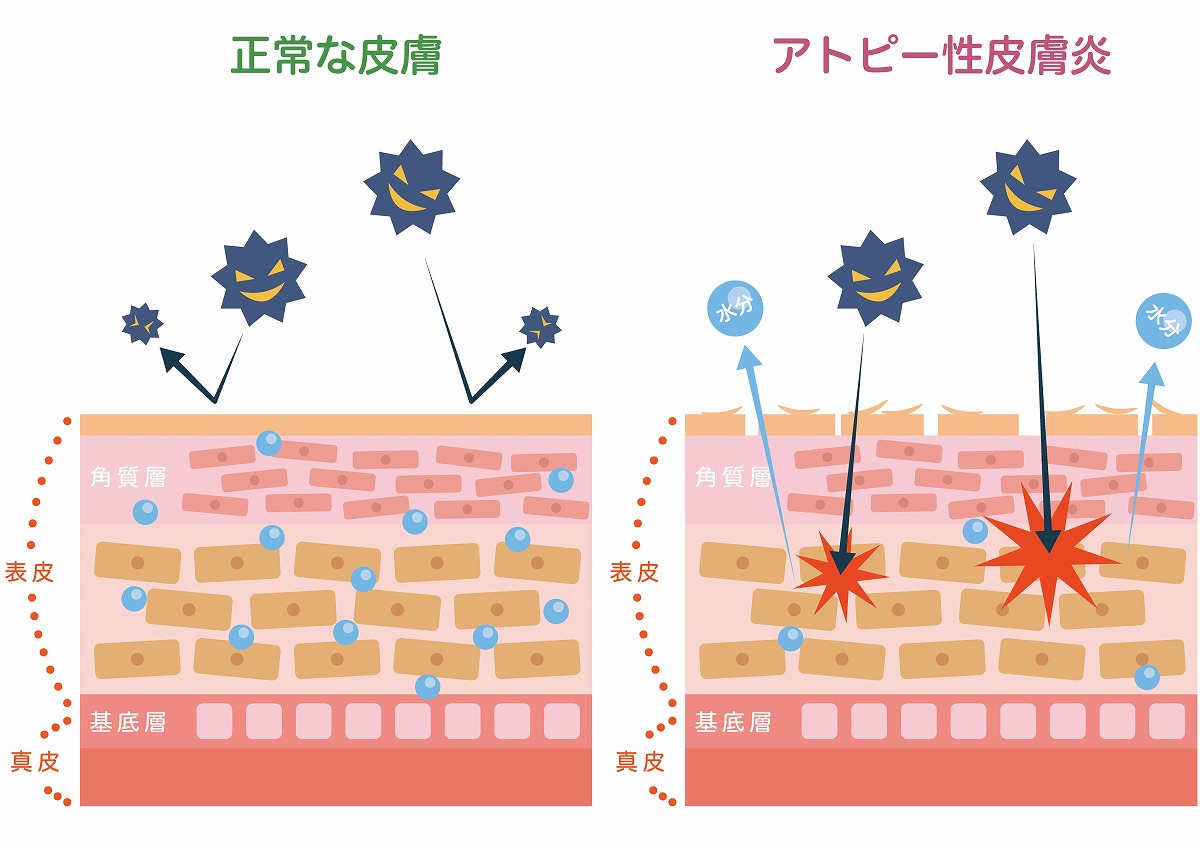 アトピー性皮膚炎とは