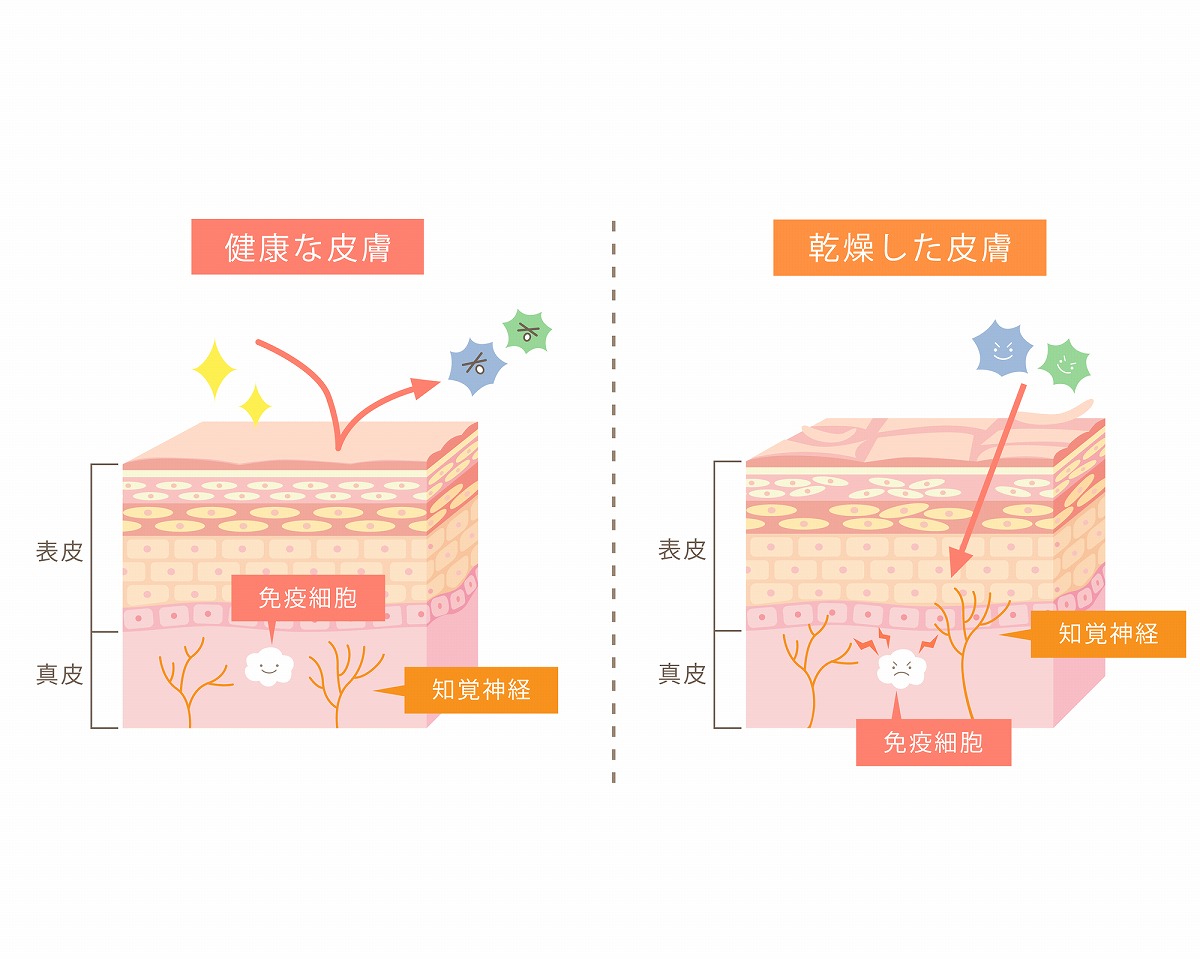 アトピー性皮膚炎の原因は？