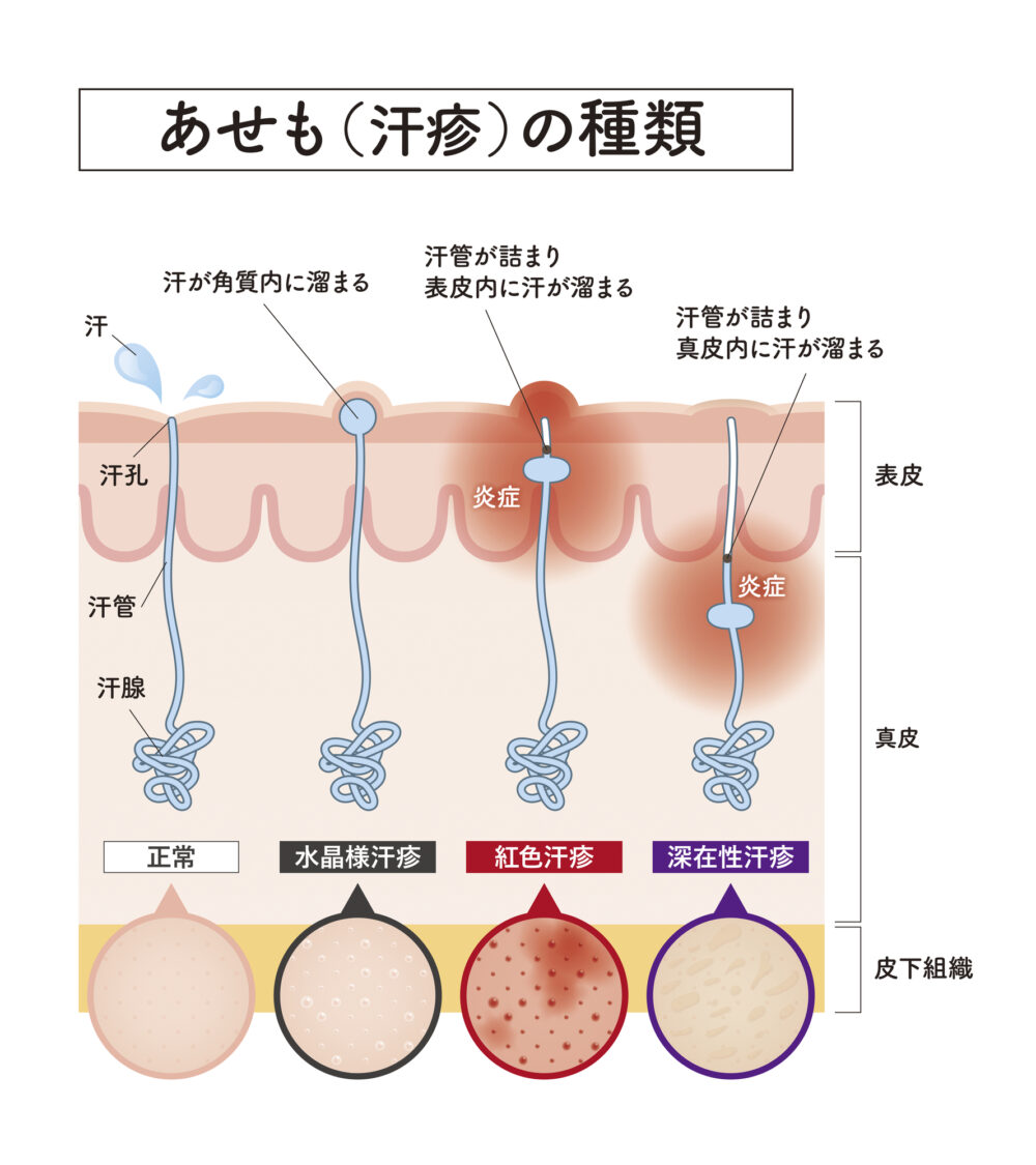 あせもの症状・できやすい場所