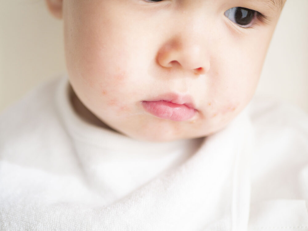 乳児期にみられる湿疹