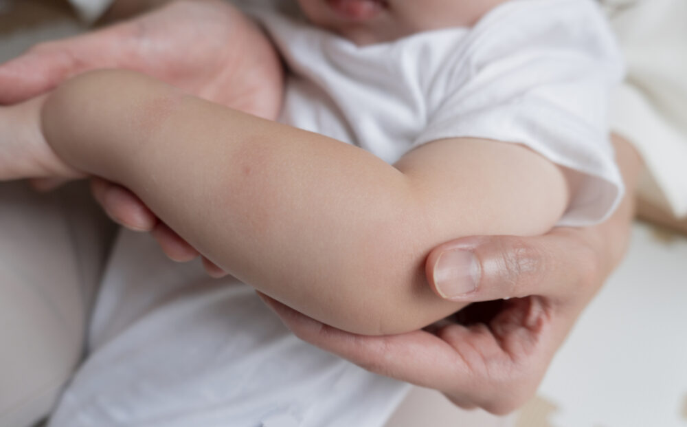 乳児湿疹の症状・ いつからいつまで続く？