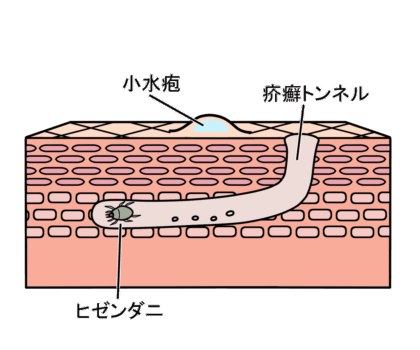 疥癬の原因は？うつる？感染経路について