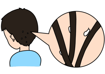 シラミ、頭ジラミとは