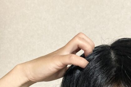 シラミ、頭ジラミの症状