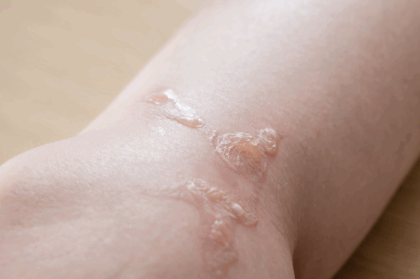 やけど（熱傷）とは