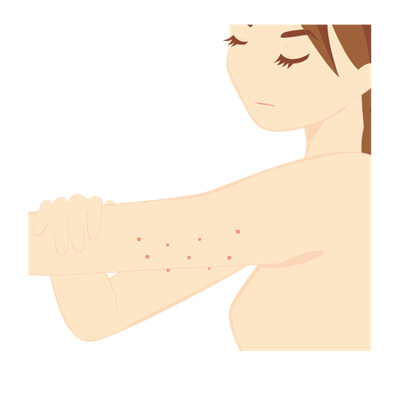 毛孔性角化症（毛孔性苔癬）とは