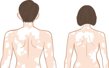 白斑の症状～肌の色が抜ける・まだら～