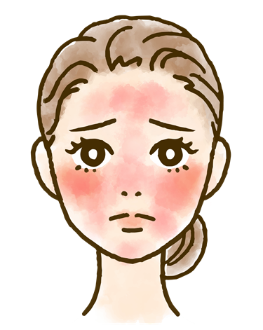 酒さ・赤ら顔とは